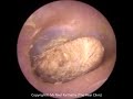 A compilation of foreign body removals  extractions from the ear canal by the wax whisperer  333