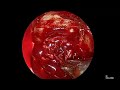 Pituitary adenoma large with suprasellar extension