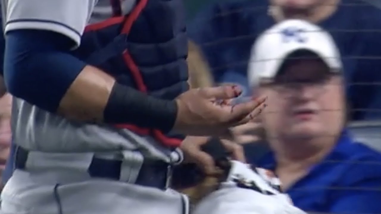 Catcher rips hand open on hitters bat, a breakdown