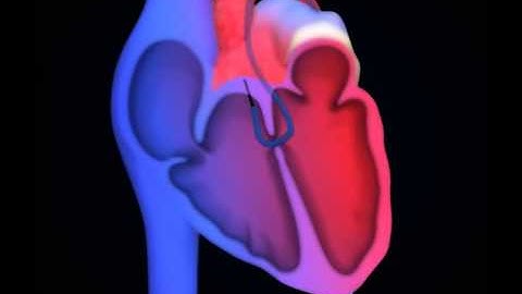 VSD device closure by Dr Nageswar Rao Koneti