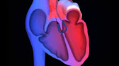 62 - TGA, VSD, narrow aortic arch - YouTube