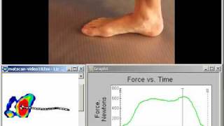MatScan Barefoot Pressure Measurement and Gait Analysis