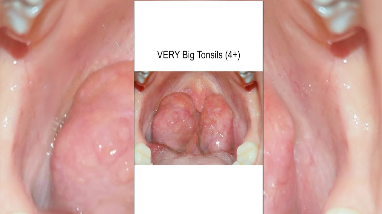 Aspiration #caséum #amygdale, #Tonsil #stone removal. Dr Danvin JB #me