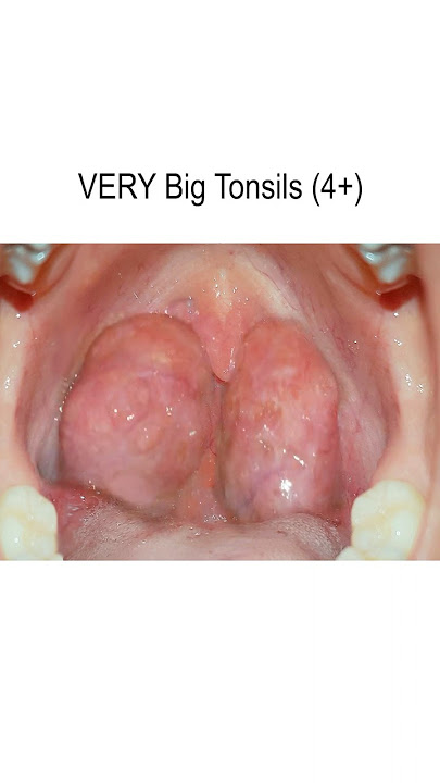 Tonsils From None to Very Big (4 ) #shorts @fauquierent