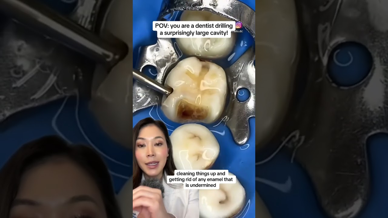 Обнаружена неожиданно большая полость! #кариес #сверление #стоматолог #большаяполость