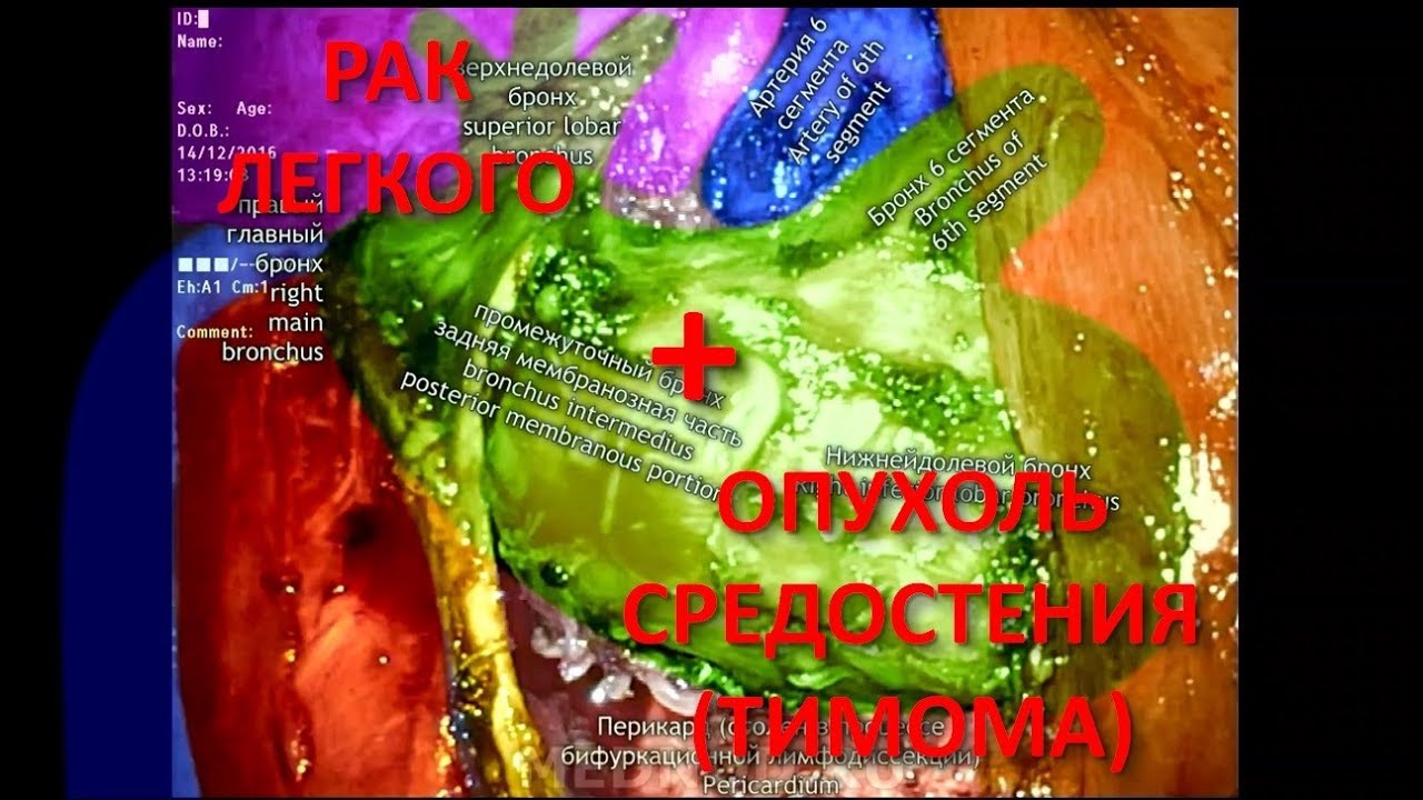 Торакоскопическое одномоментное удаление опухоли легкого (рак) и ...