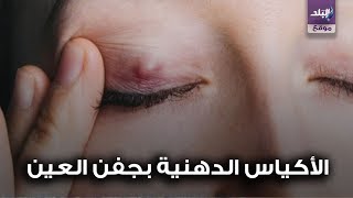 تسبب العمى| أسباب الأكياس الدهنية في جفن العين