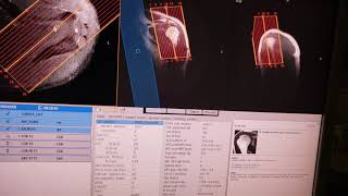 Preventing Shoulder Flipping in MRI