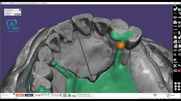 Single palatal bar type partial frame  exocad