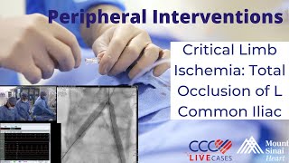 Critical Limb Ischemia: Total Occlusion of L Common Iliac - June 20. 2018