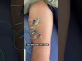 大腿二頭筋の肉離れに対する電気鍼