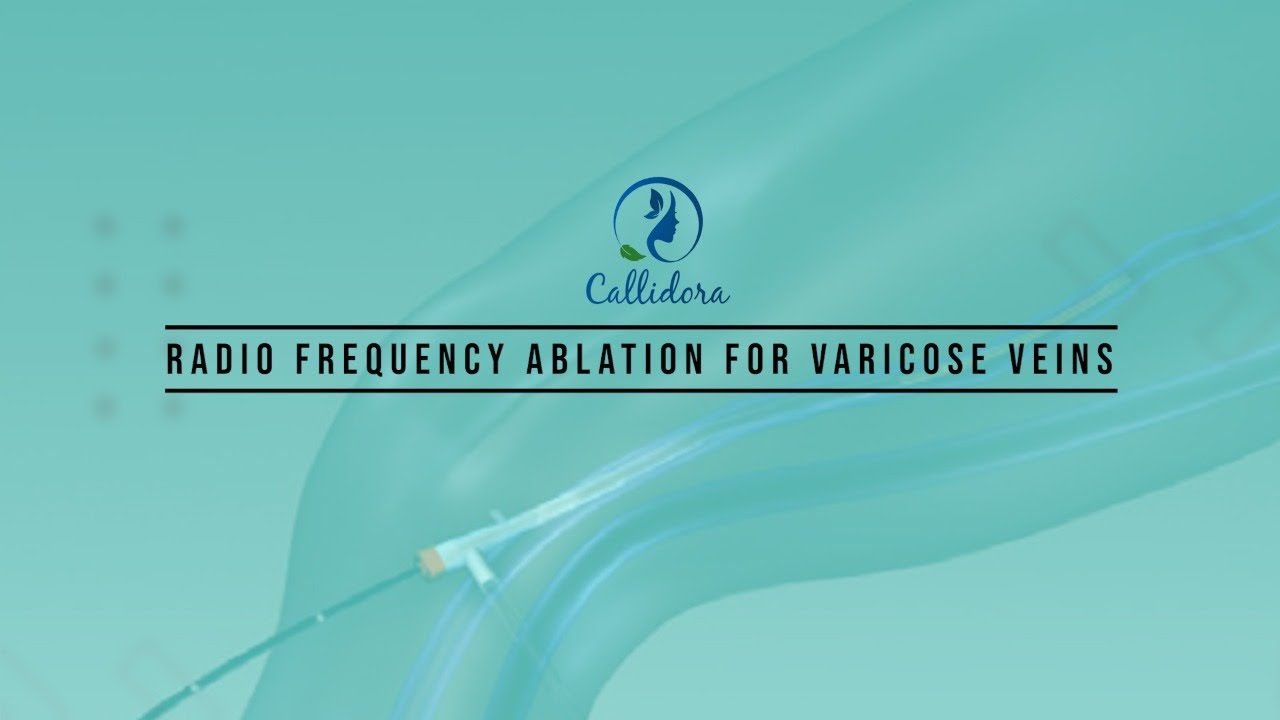 Radio frequency ablation for varicose veins youtube