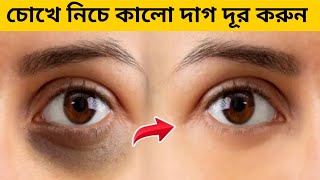 চোখের নিচে কালো দাগ ও গর্ত দূর করার উপায়। Ways to remove dark spots and holes under the eyes