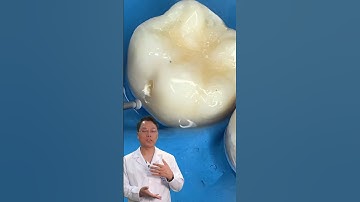 Cách xử lý lỗ sâu mặt bên cùng | Dr Cường Offical #drcuong #shorts