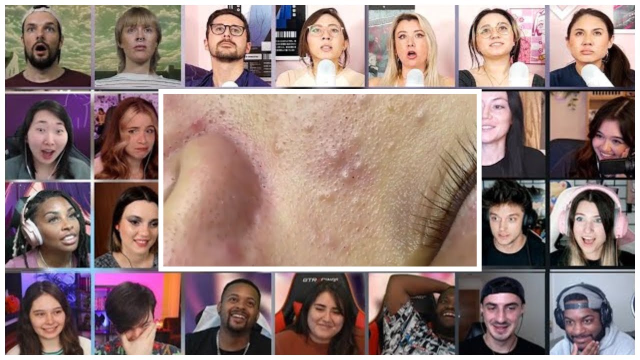 Cystic Blackheads Extraction New This Week Dr Mozan Most Disturbing Pimple Popping Reaction Mashup.