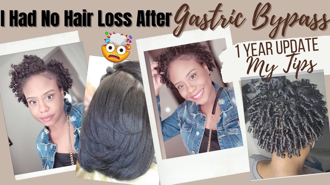 Hair Loss After Bariatric Surgery Gastric Bypass hair loss after gastric sleeve YouTube