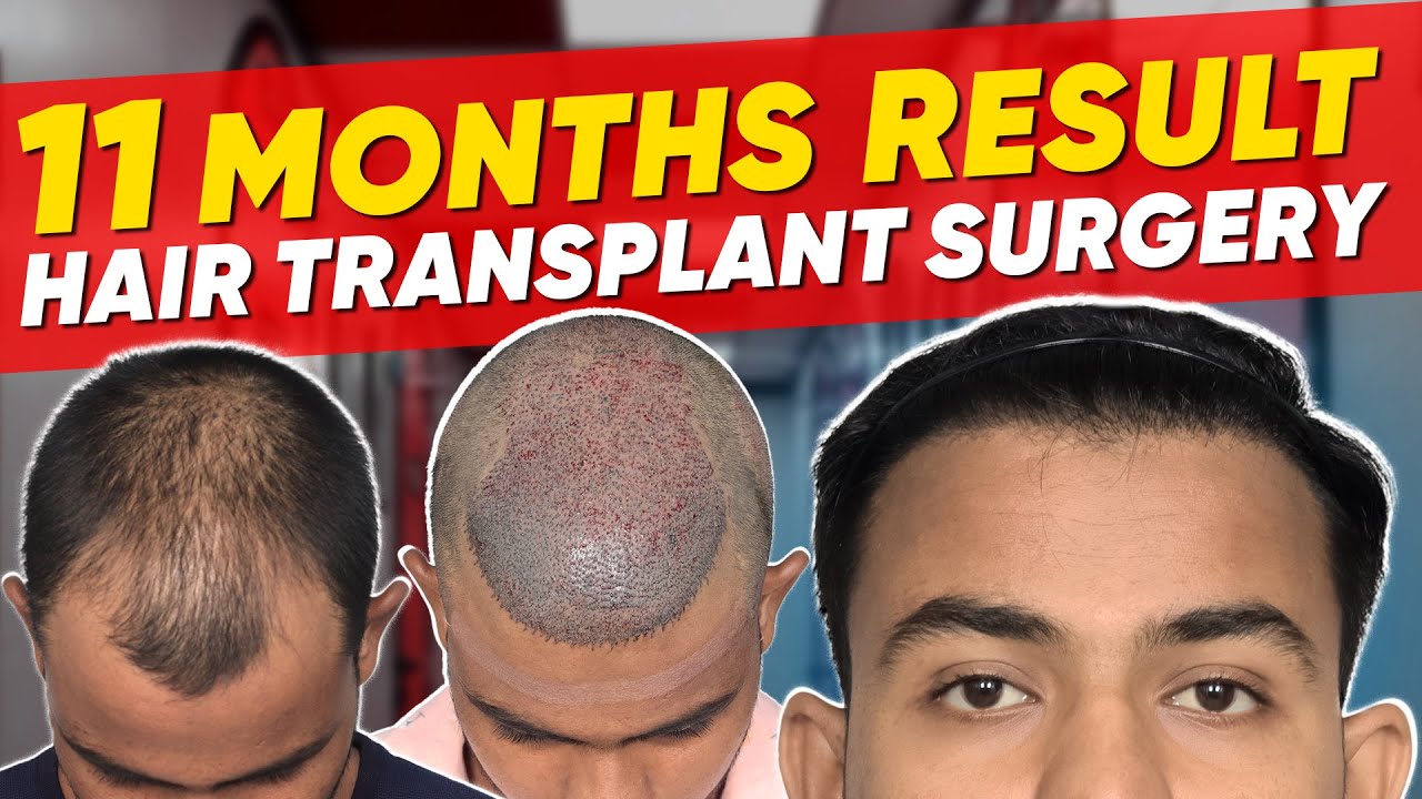 Hair Transplant in Chennai Best Results & Cost of Hair Transplant in