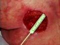 Bed Sores Pictures Stage 4