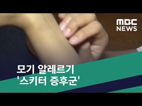 [스마트 리빙] 모기 알레르기 &rsquo;스키터 증후군&rsquo; (2019.08.07/뉴스투데이/MBC)