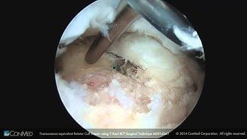 ConMed Linvatec Transosseous Equivalent Rotator Cuff Repair Using Y Knot RC® Surgical Technique