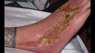 Science News - Two microbe strains interact to cause necrotizing fasciitis