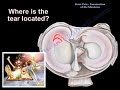 Knee Pain , Meniscus tear - Everything You Need To Know - Dr. Nabil Ebraheim