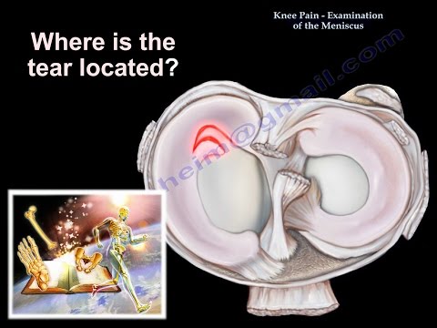 वीडियो: औसत दर्जे का मेनिस्कस आंसू के लिए आप क्या करते हैं?