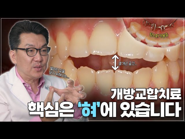 개방교합, 교정 효과를 더 높일 수 있는 방법