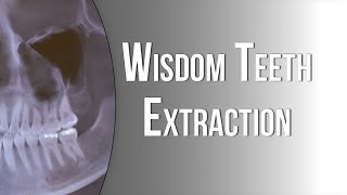 Detailed Do I need to have my wisdom teeth removed? Profile