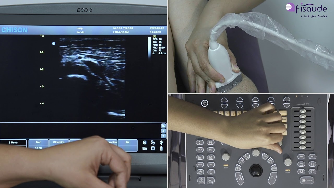 Ecografía del nervio mediano con el ecógrafo Chison Eco 2