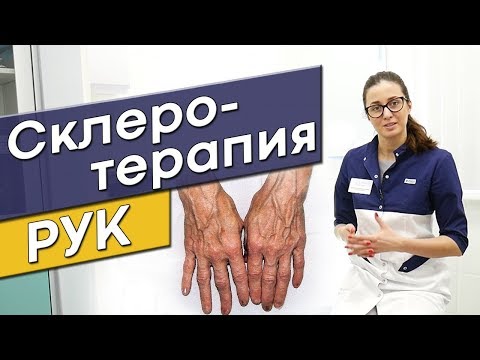 ВАРИКОЗ на руках. Что делать?