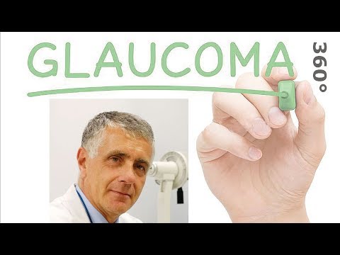 Ex-press - E. Martini - Glaucoma 360° - 2 febbraio 2019