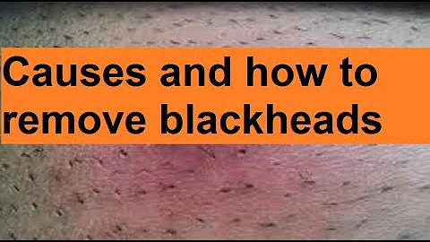 Causes and how to remove blackheads|#blackheads