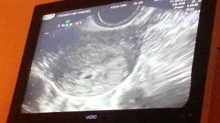 First Ultrasound @ 4 weeks 1 day.