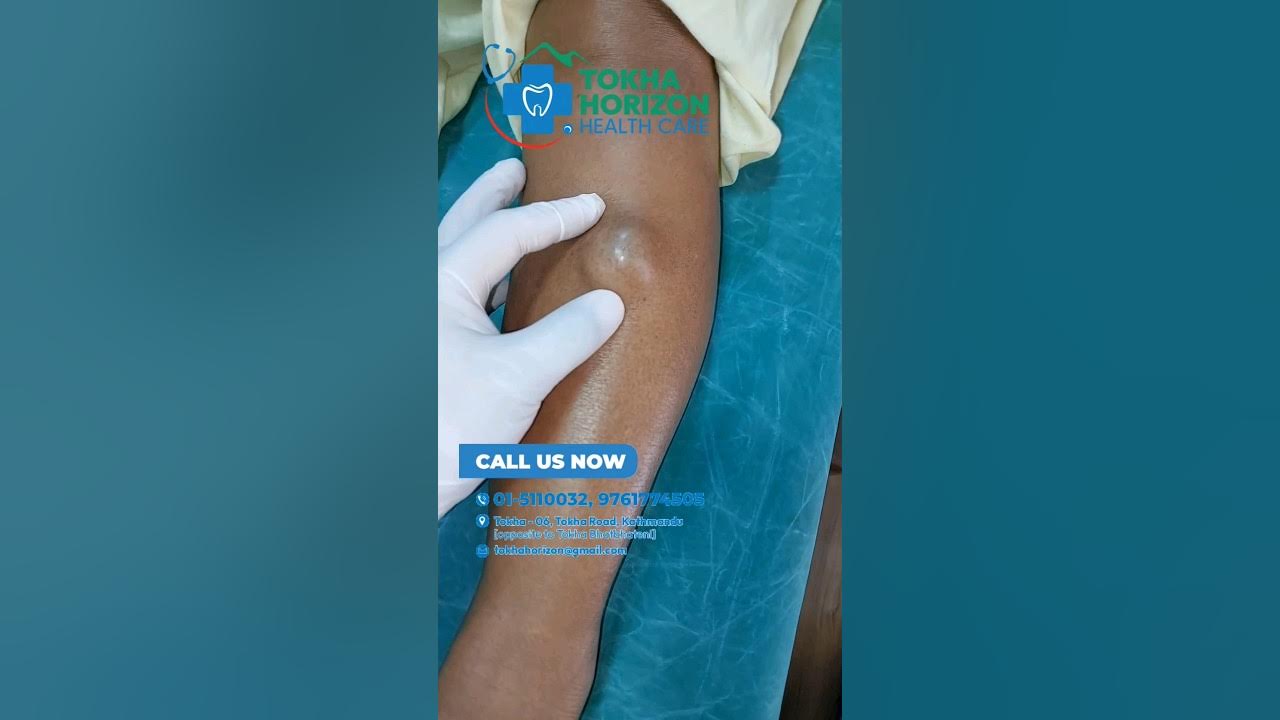 Dog Licking Cyst On Leg