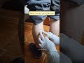 هل يعالج سم النحل الدوالي فعل ا Apitherapy For Varicose Veins 