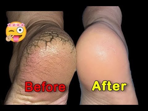 👣ПЕДИКЮР Пошагово. ТРЕЩИНЫ НА ПЯТКАХ. Классический педикюр ДОМА. DIY Pedicure at Home.DEEP FOOT CORN