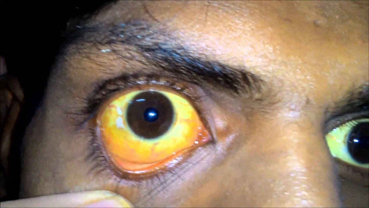 Home Remedies for Jaundice | Hepatitis | Liver jaundice 