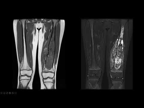 Vídeo: Significado Clínico Do B7-H3 Solúvel No Soro Em Pacientes Com Osteossarcoma