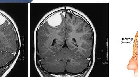 ¿Puede la TC detectar un tumor cerebral?