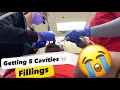 Escape dental nightmares my experience with 5 cavities fillings  dentist toothcare