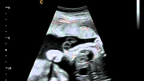 Chison Q5 Very clear image and video of Fetal Heart -Neonatal Ultrasound machine