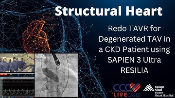 Redo TAVR for Degenerated TAV in a CKD Patient using SAPIEN 3 Ultra RESILIA