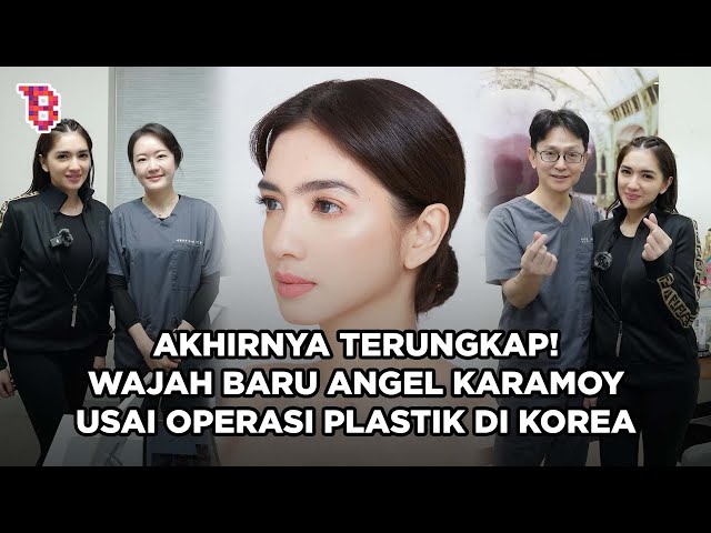 Potret terbaru Angel Karamoy usai operasi plastik di Korea, dipuji cantik natural class=