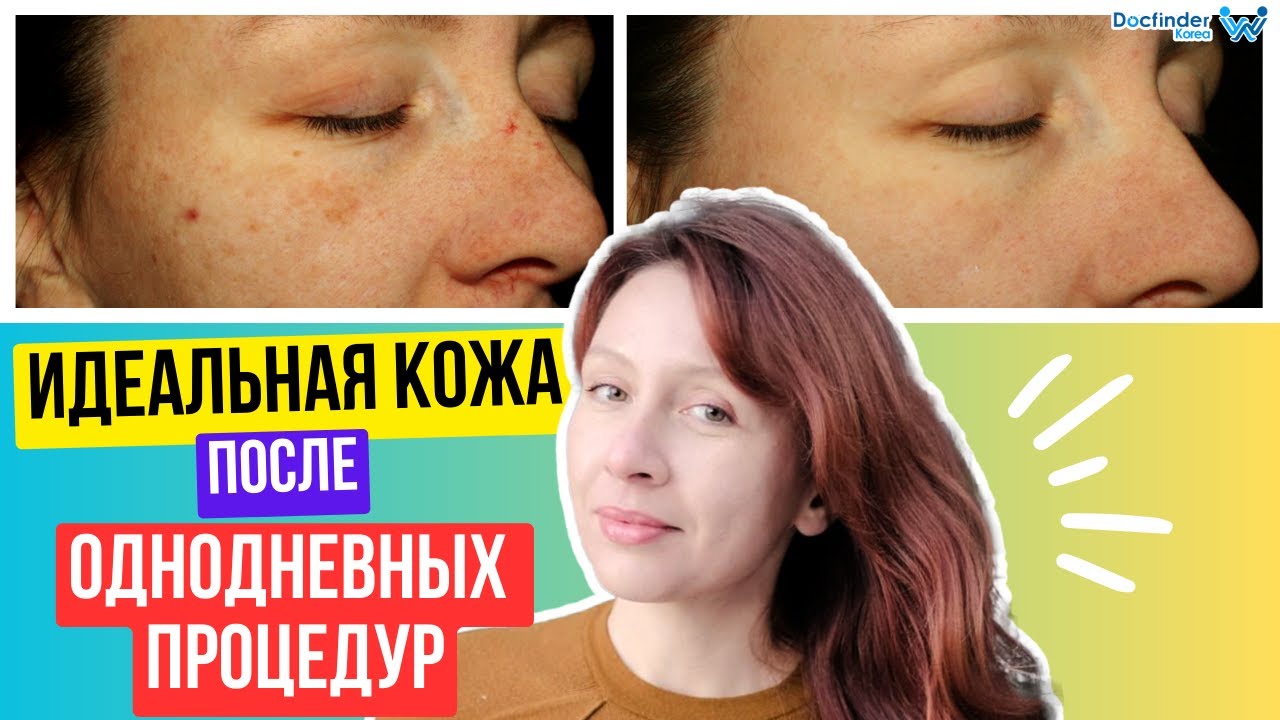Как избавиться от ПИГМЕНТАЦИИ, ПОСТАКНЕ и РАСШИРЕННЫХ ПОР ...
