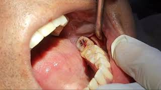 Lower Wisdom Tooth Surgical Extraction Live Dental Vlog
