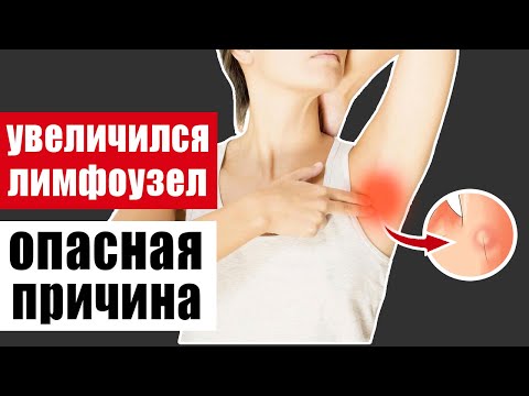 Увеличился лимфоузел: неожиданно