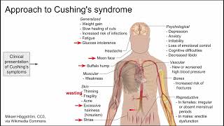 Approach to Cushing's syndrome