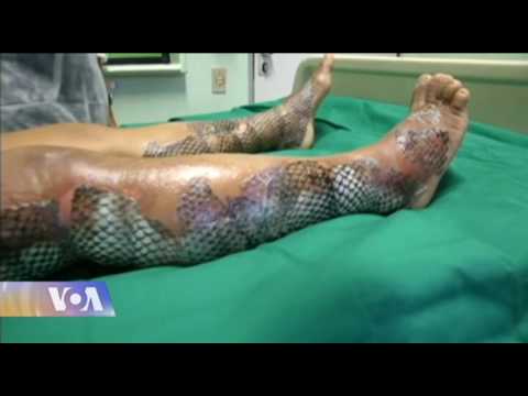 დამწვრობის სამკურნალო ერთ-ერთი მეთოდი