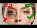 كيفية التخلص من الهالات السوداء تحت العين نهائيا طرق فعالة ومجربة